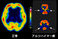 SPECT画像